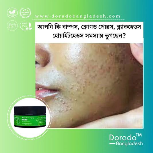 openpores, blackheads, Matcha Detoxifying Face Mask, bumps, open pores treatment in bd